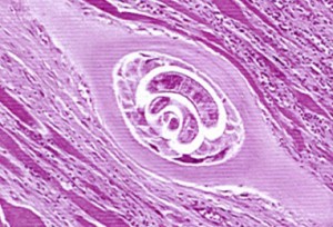 triquinosis
