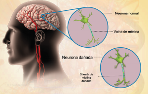 Neuromielitis óptica