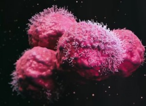 cancer prostata