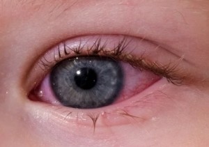 conjuntivitis