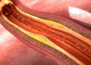 Atereoesclerosis