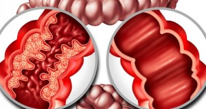 enfermedad crohn